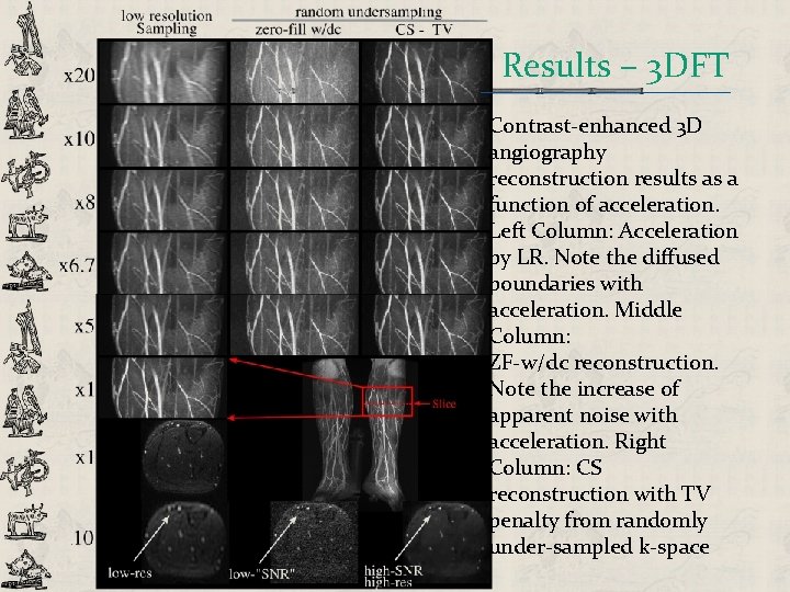 Results – 3 DFT Contrast-enhanced 3 D angiography reconstruction results as a function of