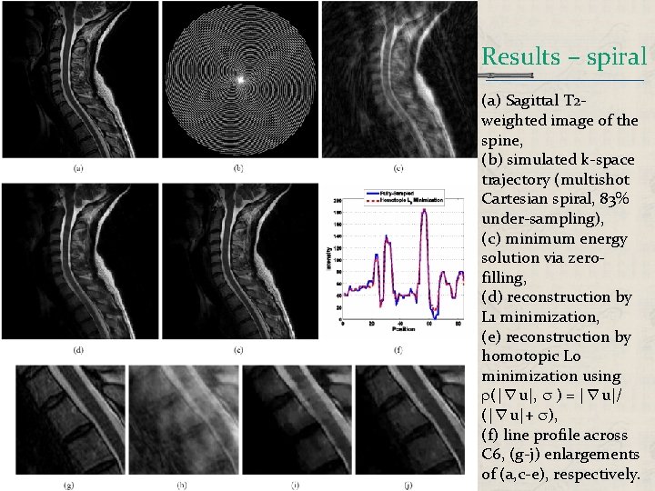 Results – spiral (a) Sagittal T 2 weighted image of the spine, (b) simulated