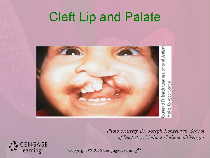 Cleft Lip and Palate Photo courtesy Dr. Joseph Konzelman, School of Dentistry, Medical College