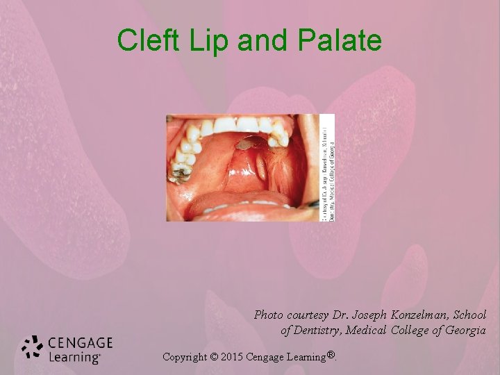 Cleft Lip and Palate Photo courtesy Dr. Joseph Konzelman, School of Dentistry, Medical College