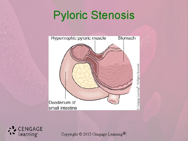 Pyloric Stenosis Copyright © 2015 Cengage Learning®. 