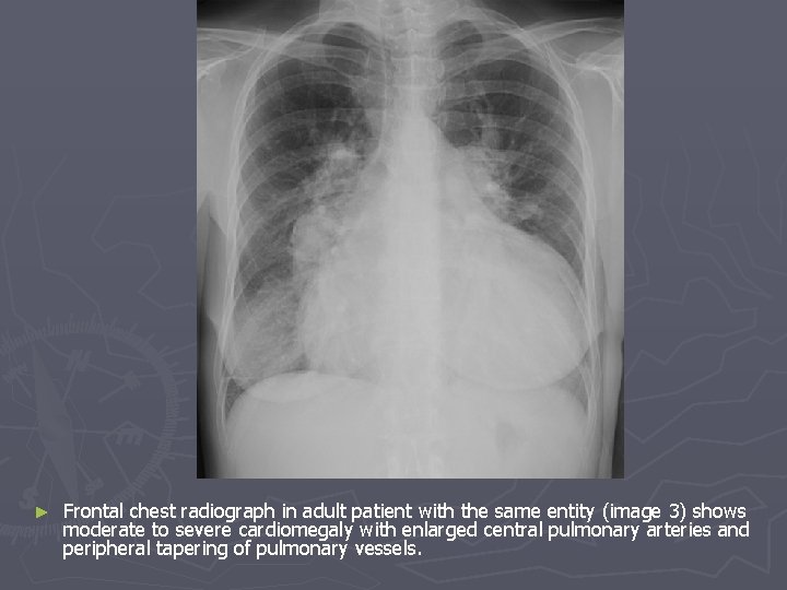 ► Frontal chest radiograph in adult patient with the same entity (image 3) shows