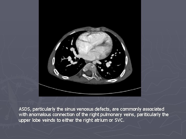 ASDS, particularly the sinus venosus defects, are commonly associated with anomalous connection of the