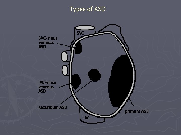 Types of ASD 
