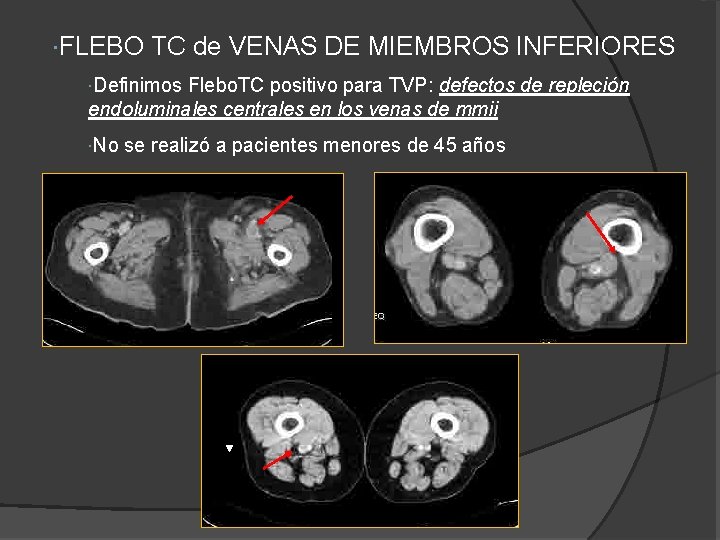 FLEBO TC de VENAS DE MIEMBROS INFERIORES Definimos Flebo. TC positivo para TVP: FLEBO TC de VENAS DE MIEMBROS INFERIORES Definimos Flebo. TC positivo para TVP: