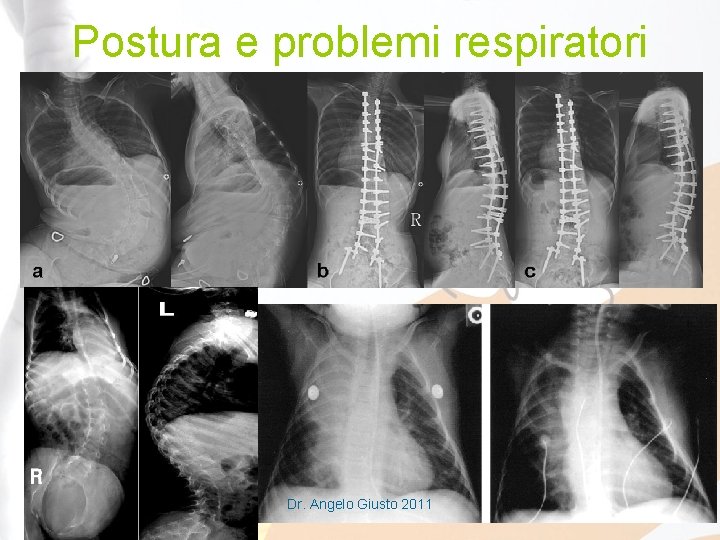 Postura e problemi respiratori Dr. Angelo Giusto 2011 