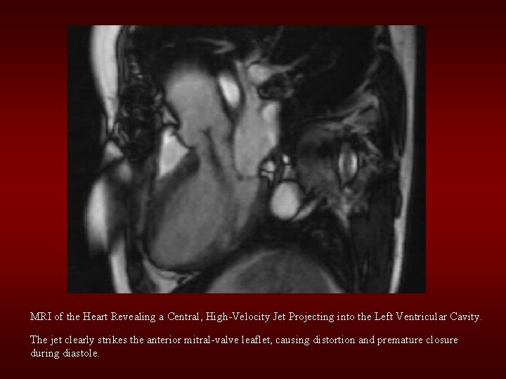 MRI of the Heart Revealing a Central, High-Velocity Jet Projecting into the Left Ventricular MRI of the Heart Revealing a Central, High-Velocity Jet Projecting into the Left Ventricular
