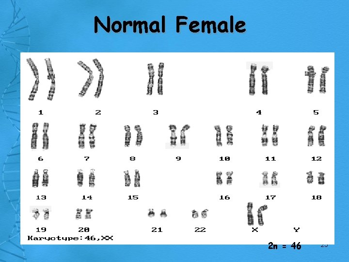 Normal Female 2 n = 46 25 