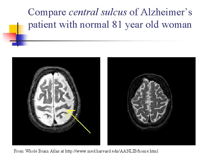 Compare central sulcus of Alzheimer’s patient with normal 81 year old woman From Whole