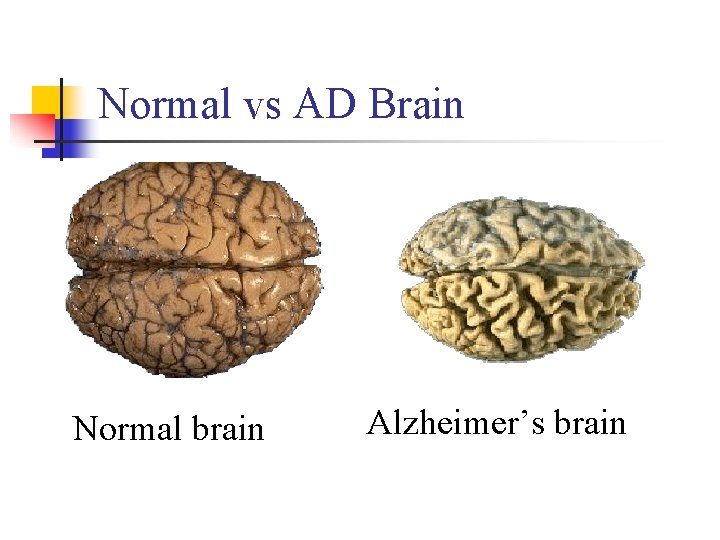 Normal vs AD Brain Normal brain Alzheimer’s brain 