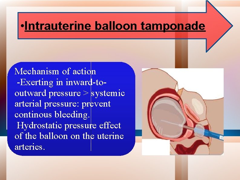  • Intrauterine balloon tamponade Mechanism of action -Exerting in inward-tooutward pressure > systemic