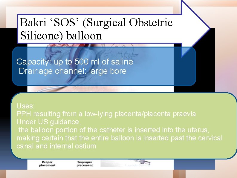 Bakri ‘SOS’ (Surgical Obstetric Silicone) balloon Capacity: up to 500 ml of saline Drainage