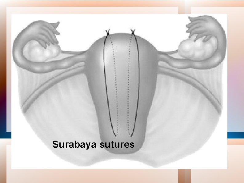 Surabaya sutures 