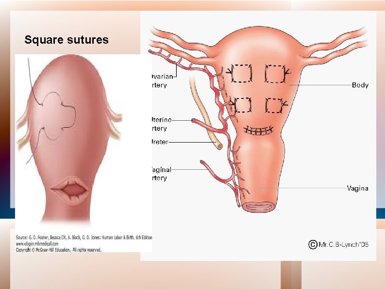 Square sutures 