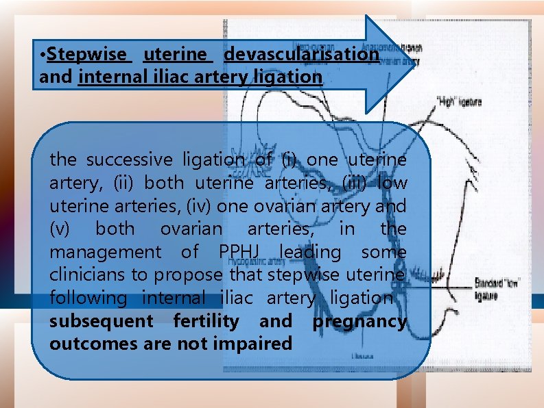  • Stepwise uterine devascularisation and internal iliac artery ligation the successive ligation of