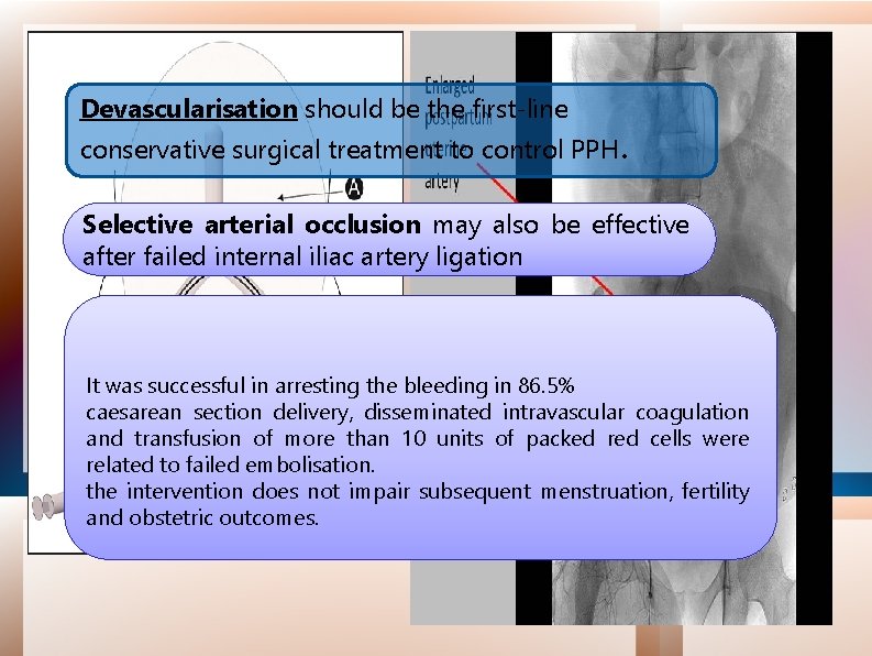 Devascularisation should be the first-line conservative surgical treatment to control PPH. Selective arterial occlusion