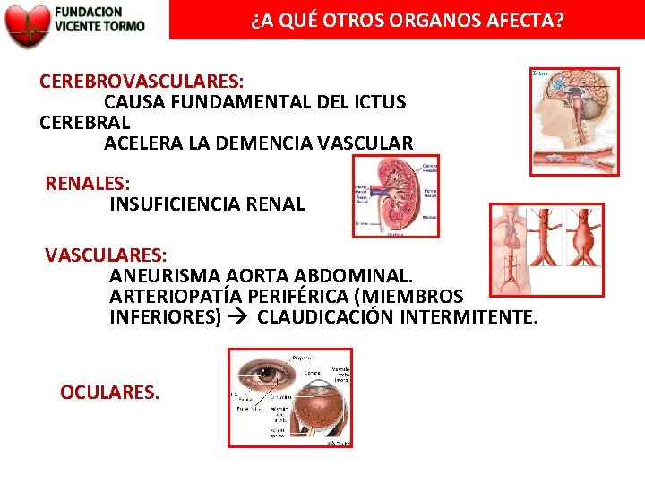 ¿A QUÉ OTROS ORGANOS AFECTA? CEREBROVASCULARES: CAUSA FUNDAMENTAL DEL ICTUS CEREBRAL ACELERA LA DEMENCIA