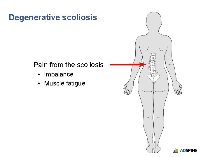 Degenerative scoliosis Pain from the scoliosis • Imbalance • Muscle fatigue 