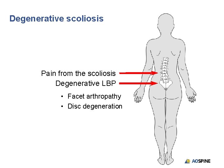 Degenerative scoliosis Pain from the scoliosis Degenerative LBP • Facet arthropathy • Disc degeneration