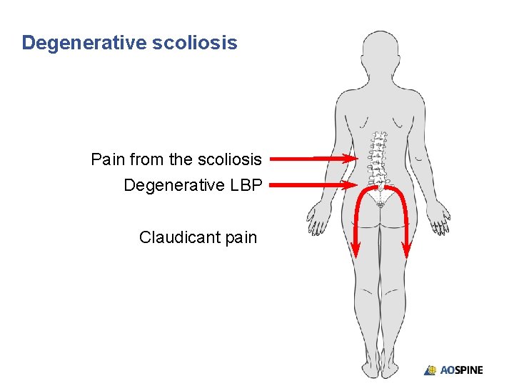 Degenerative scoliosis Pain from the scoliosis Degenerative LBP Claudicant pain 