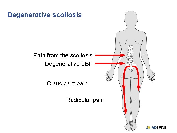 Degenerative scoliosis Pain from the scoliosis Degenerative LBP Claudicant pain Radicular pain 
