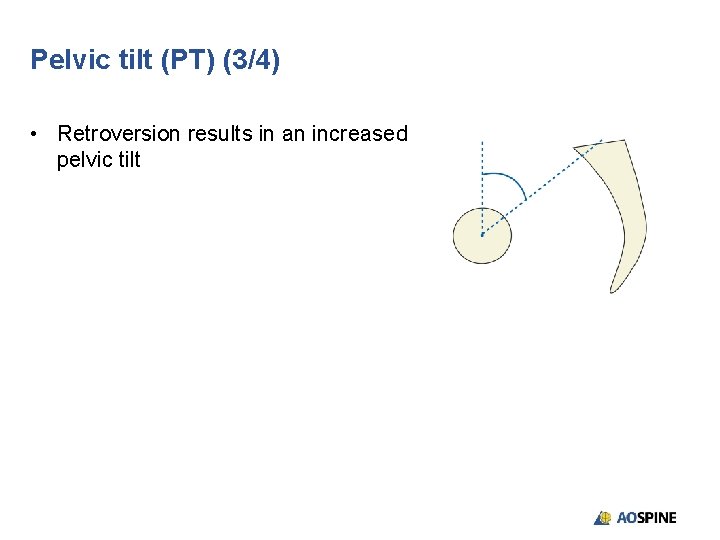 Pelvic tilt (PT) (3/4) • Retroversion results in an increased pelvic tilt 