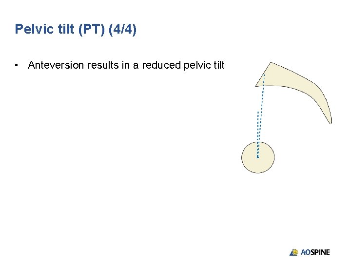 Pelvic tilt (PT) (4/4) • Anteversion results in a reduced pelvic tilt 