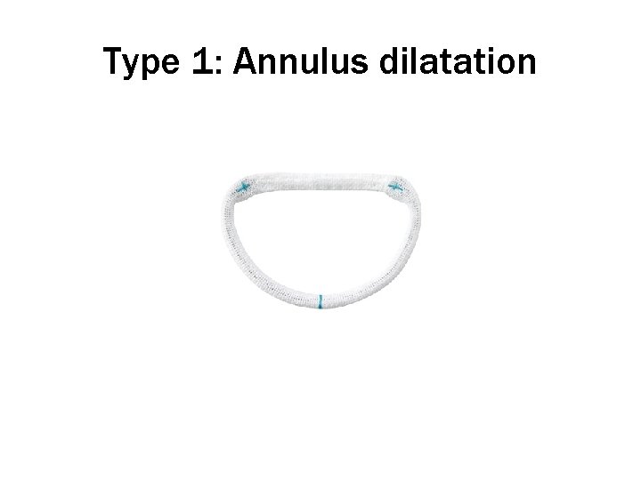 Type 1: Annulus dilatation 