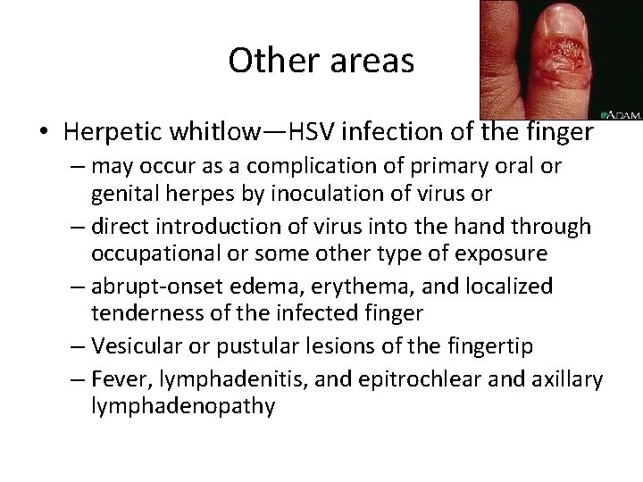 Other areas • Herpetic whitlow—HSV infection of the finger – may occur as a