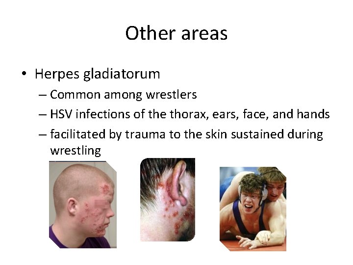 Other areas • Herpes gladiatorum – Common among wrestlers – HSV infections of the