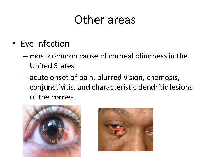 Other areas • Eye Infection – most common cause of corneal blindness in the