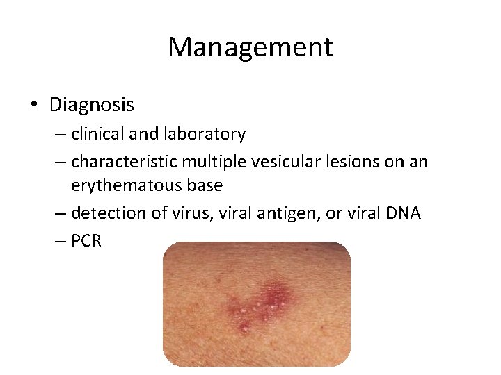 Management • Diagnosis – clinical and laboratory – characteristic multiple vesicular lesions on an