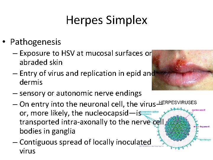 Herpes Simplex • Pathogenesis – Exposure to HSV at mucosal surfaces or abraded skin