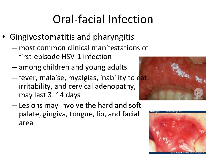 Oral-facial Infection • Gingivostomatitis and pharyngitis – most common clinical manifestations of first-episode HSV-1