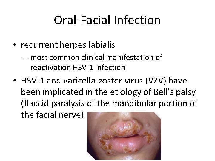 Oral-Facial Infection • recurrent herpes labialis – most common clinical manifestation of reactivation HSV-1