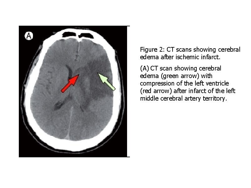 Figure 2: CT scans showing cerebral edema after ischemic infarct. (A) CT scan showing