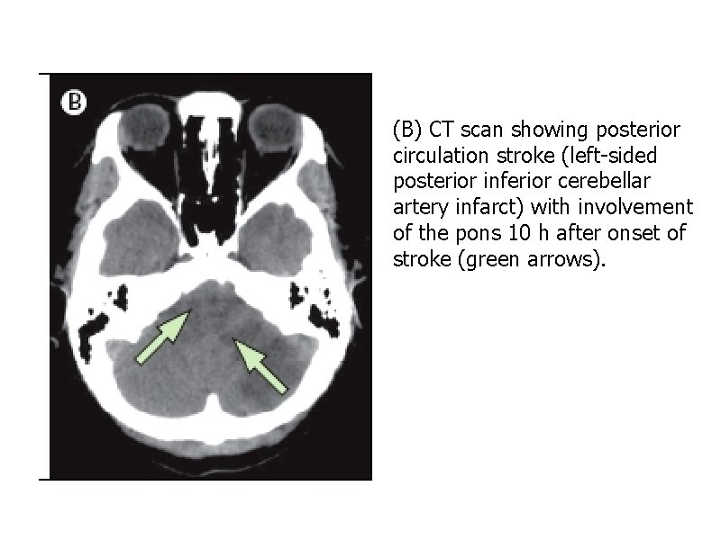 (B) CT scan showing posterior circulation stroke (left-sided posterior inferior cerebellar artery infarct) with