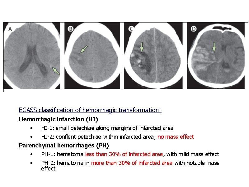 Haemorrhagic transformation ECASS classification of hemorrhagic transformation: Hemorrhagic infarction (HI) • HI-1: small petechiae