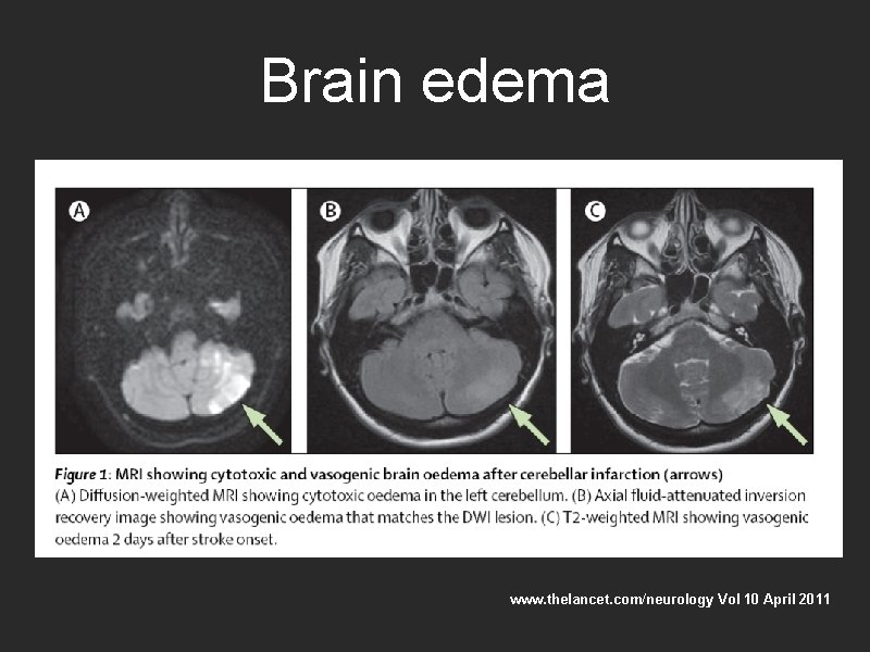 Brain edema www. thelancet. com/neurology Vol 10 April 2011 