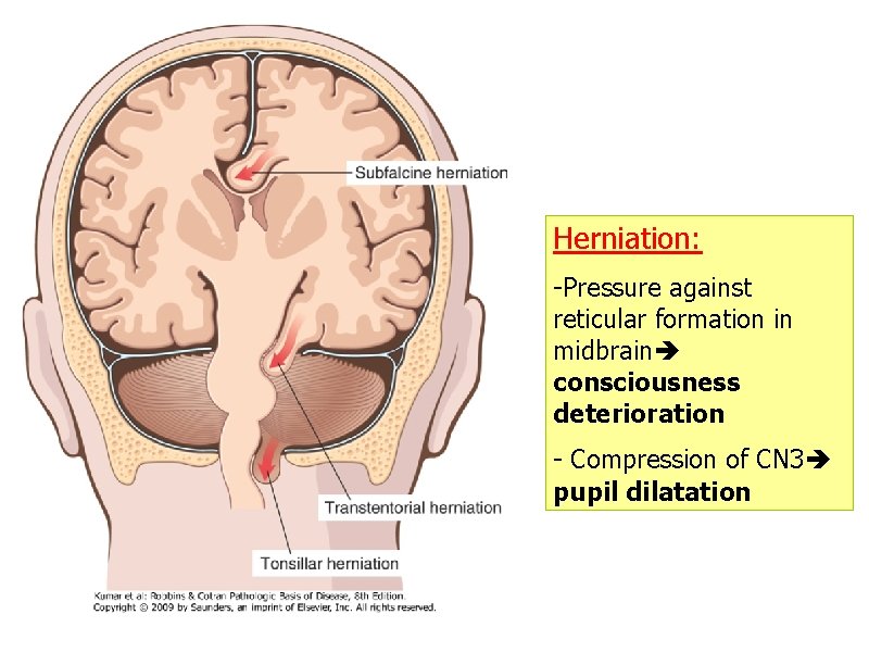 Herniation: -Pressure against reticular formation in midbrain consciousness deterioration - Compression of CN 3