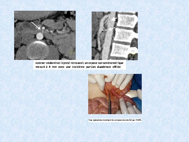 scanner abdominal injecté retrouvait un espace aortomésentérique mesuré à 4 mm avec une troisième