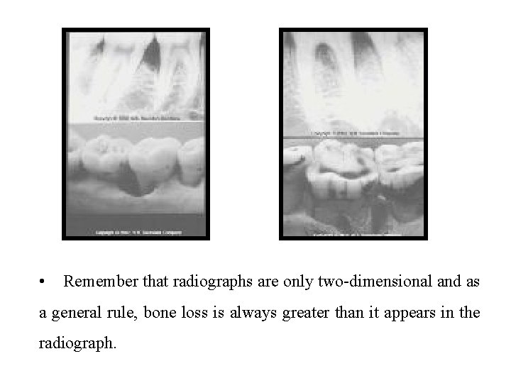  • Remember that radiographs are only two-dimensional and as a general rule, bone