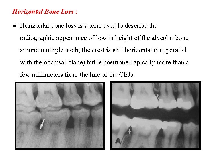 Horizontal Bone Loss : l Horizontal bone loss is a term used to describe