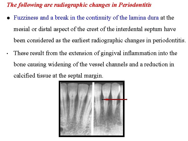 The following are radiographic changes in Periodontitis l Fuzziness and a break in the