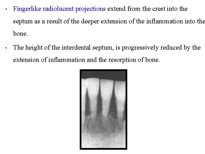  • Fingerlike radiolucent projections extend from the crest into the septum as a