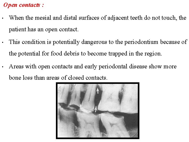 Open contacts : • When the mesial and distal surfaces of adjacent teeth do