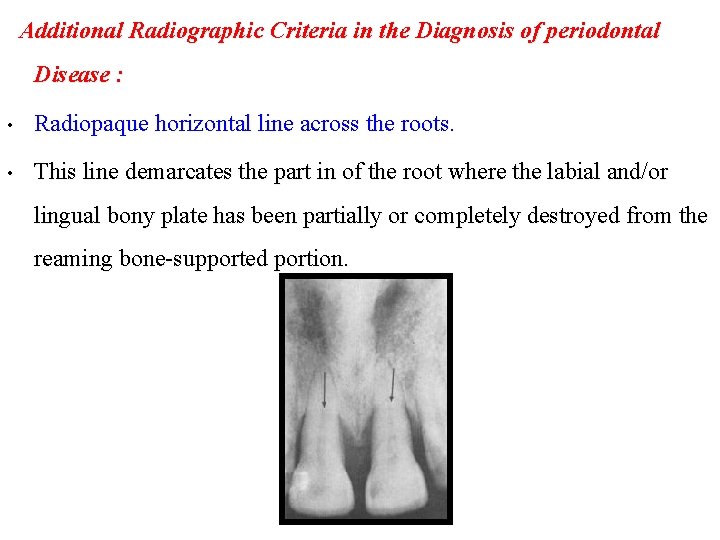 Additional Radiographic Criteria in the Diagnosis of periodontal Disease : • Radiopaque horizontal line