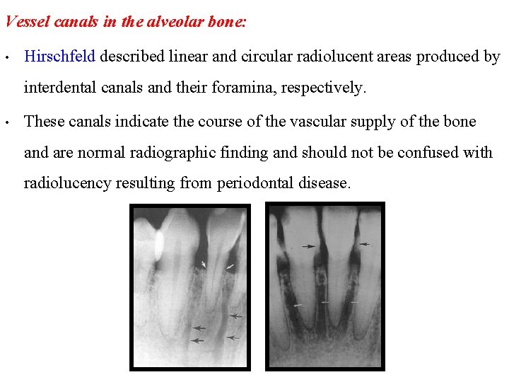 Vessel canals in the alveolar bone: • Hirschfeld described linear and circular radiolucent areas