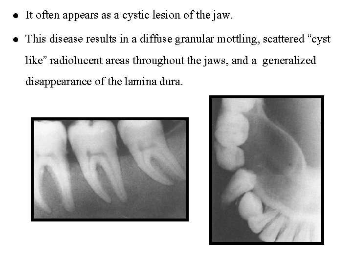 l It often appears as a cystic lesion of the jaw. l This disease