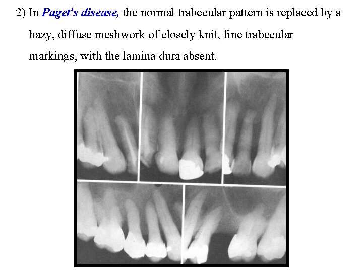 2) In Paget’s disease, the normal trabecular pattern is replaced by a hazy, diffuse